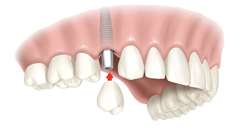 Single Dental Implants Sacramento