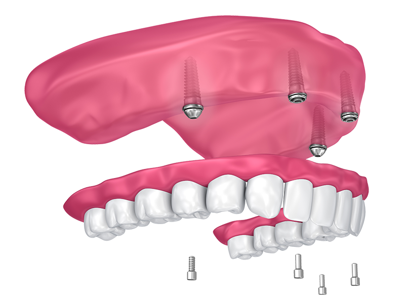 Full Mouth Hybrid Teeth Solutions