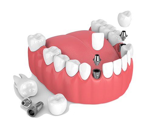 Multiple Teeth Dental Implants in Virginia
